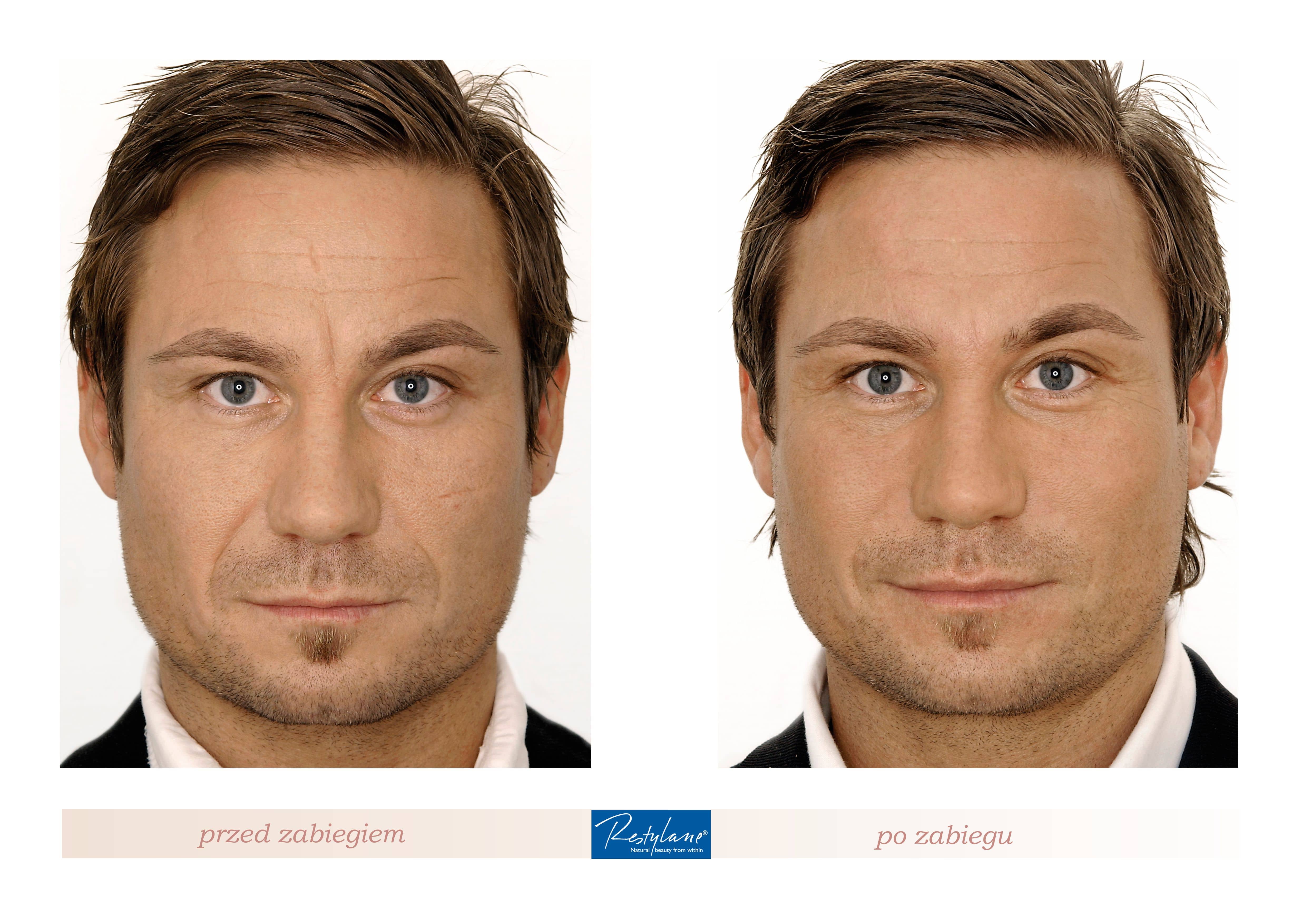 rewitalizacja skóry dla mężczyzn wypełnienie bruzd.jpg