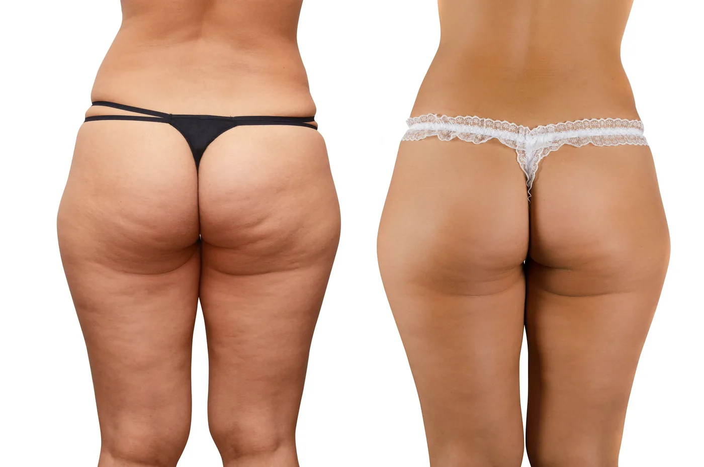 Body contouring treatment at NL Clinic in Katowice