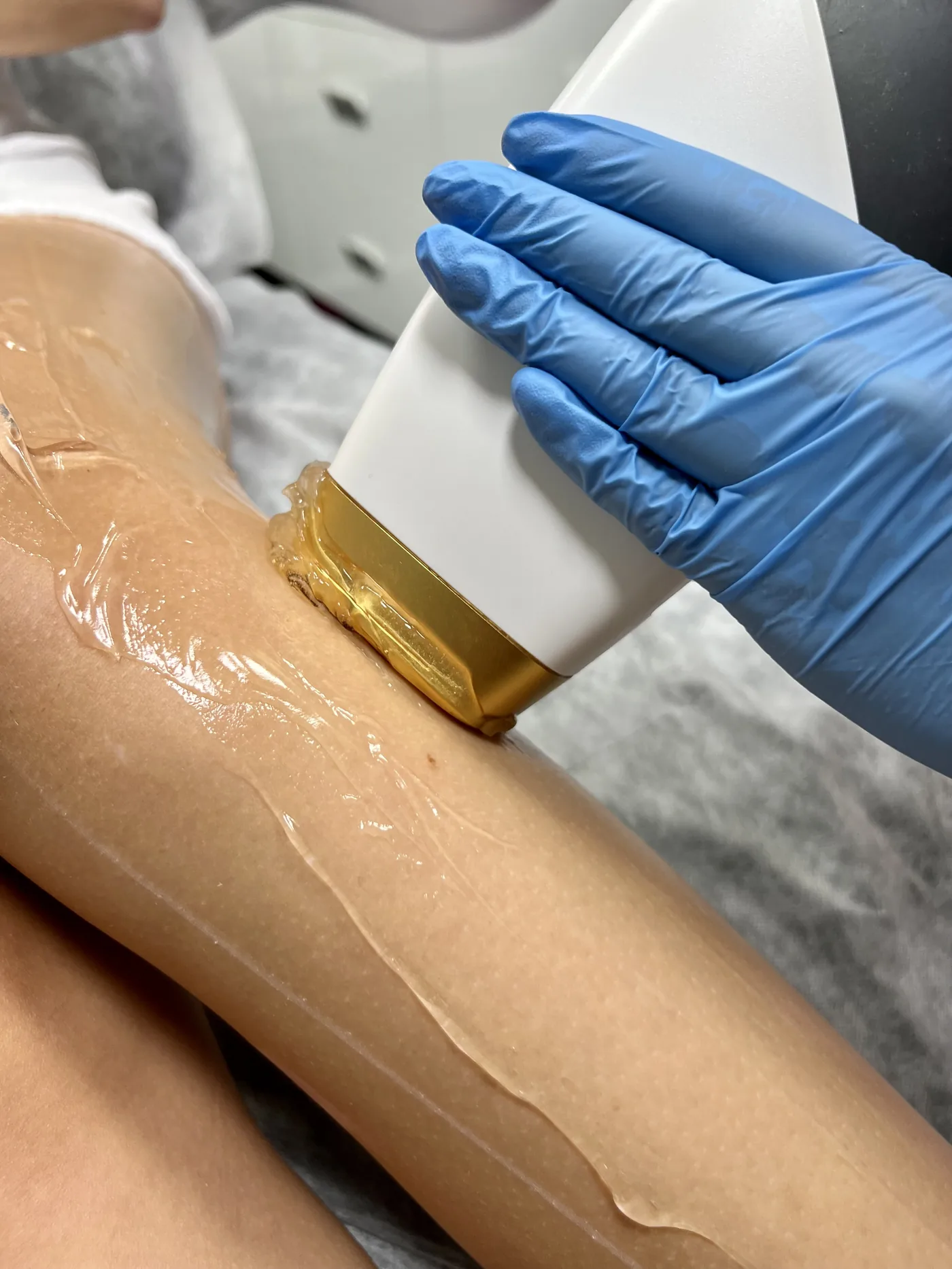 Laser hair removal with a diode laser in the NL Clinic treatment room in Katowice