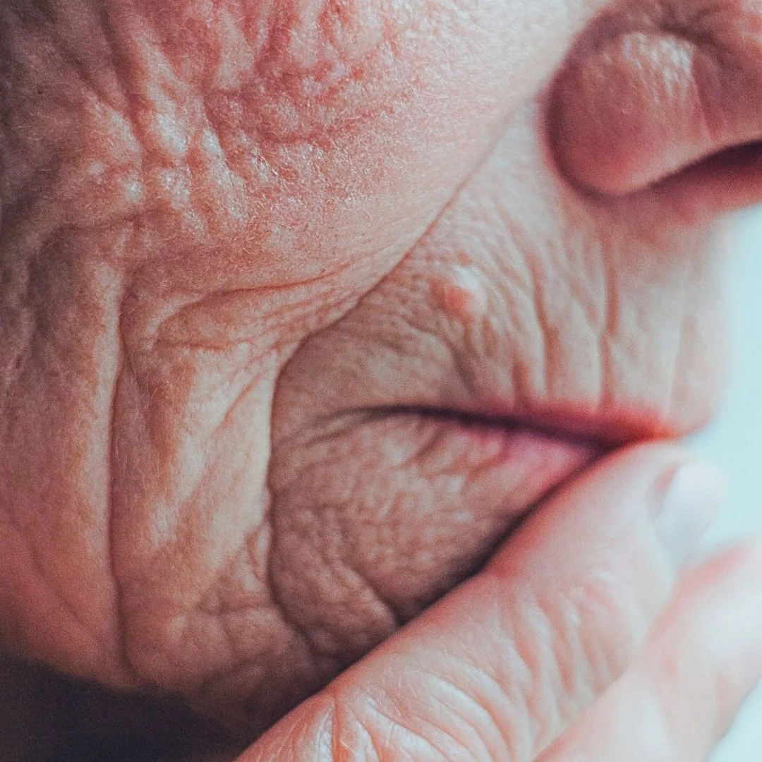 Effects of skin photoageing, information material from NL Clinic in Katowice