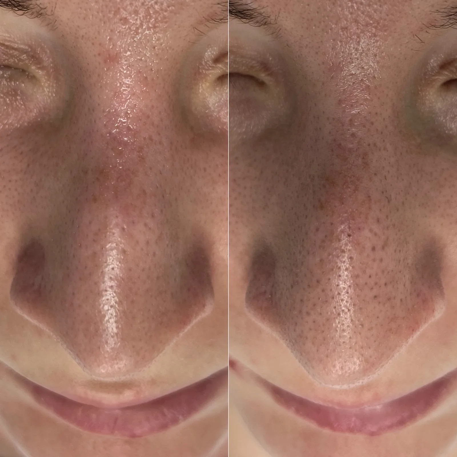 Nos i górna warga przed hydradermabrazją kwasową i tuż po pierwszym zabiegu, zestawienie zdjęć