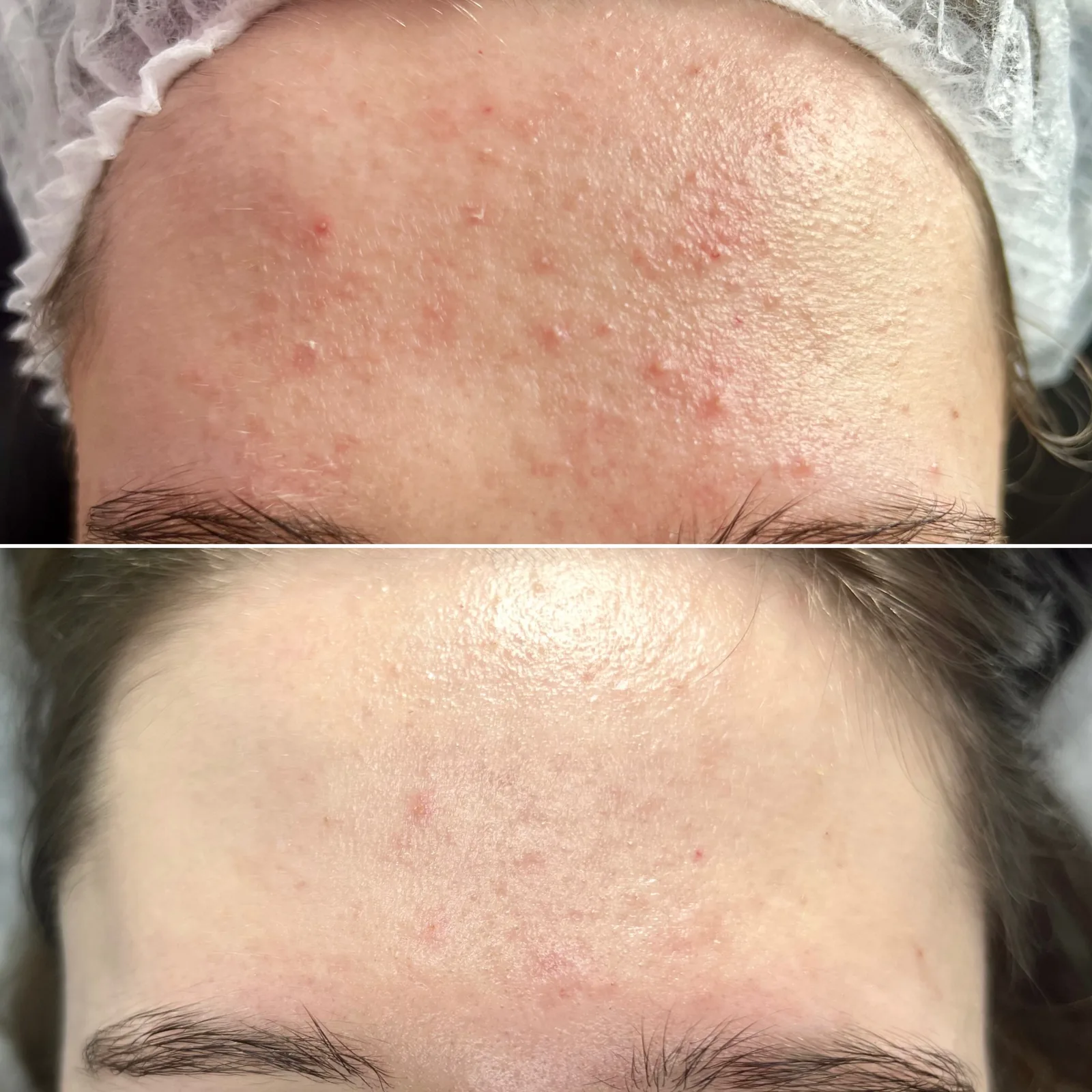 Forehead skin before and after a chemical peel, photo comparison with one picture above the other
