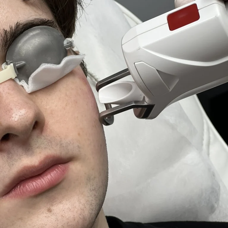 The fractional laser handpiece during a facial treatment at NL Clinic