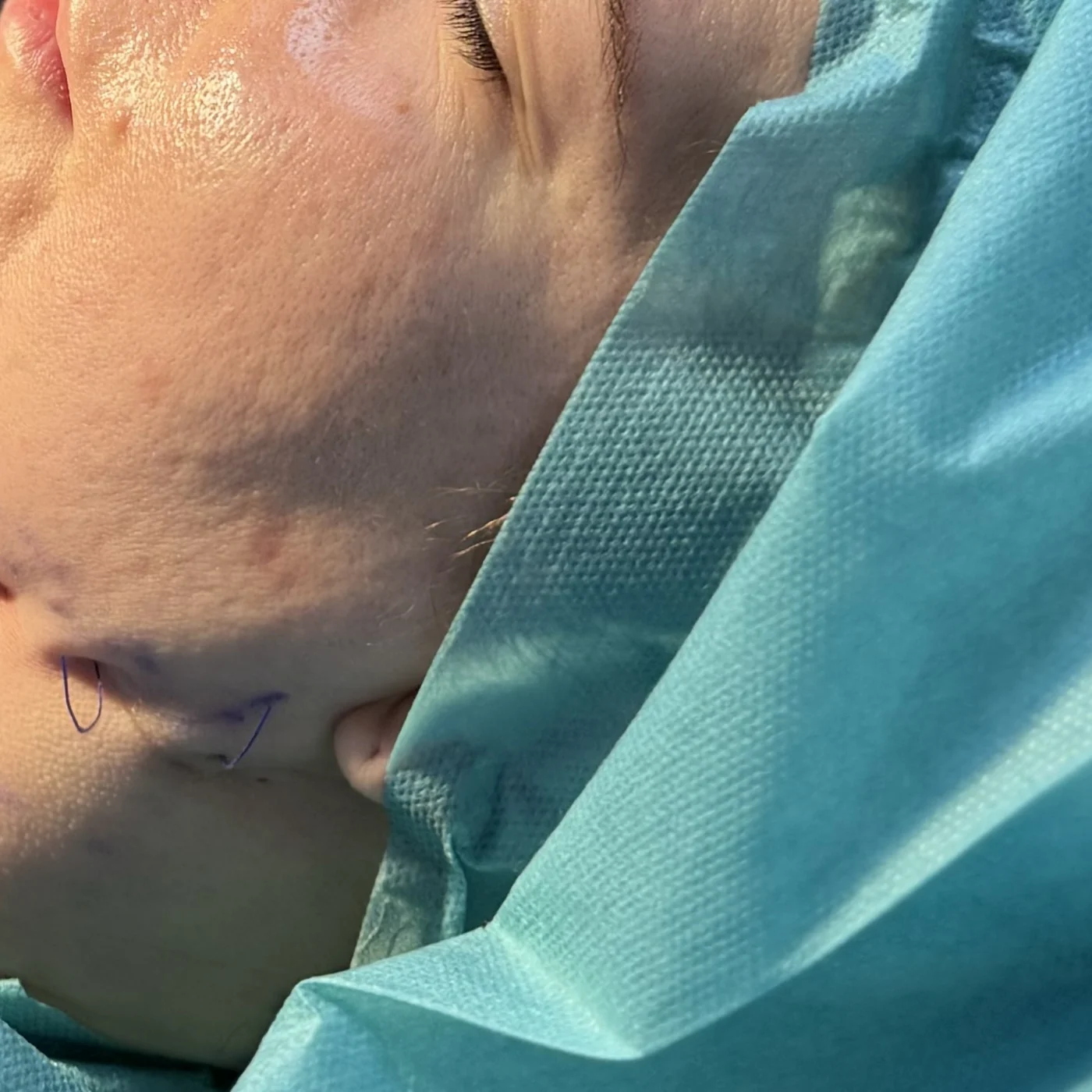 Thread implantation at the NL Clinic practice in Katowice