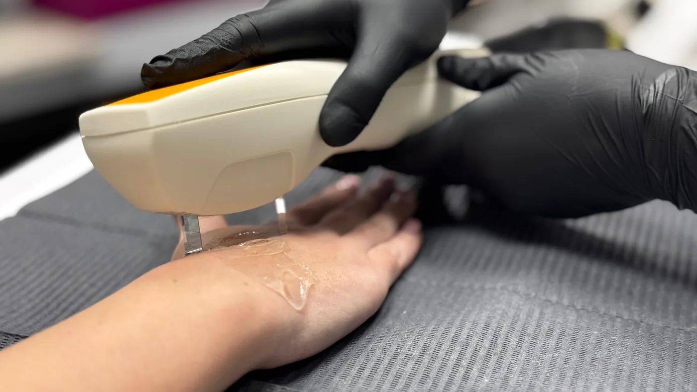 IPL treatment at NL Clinic in Katowice
