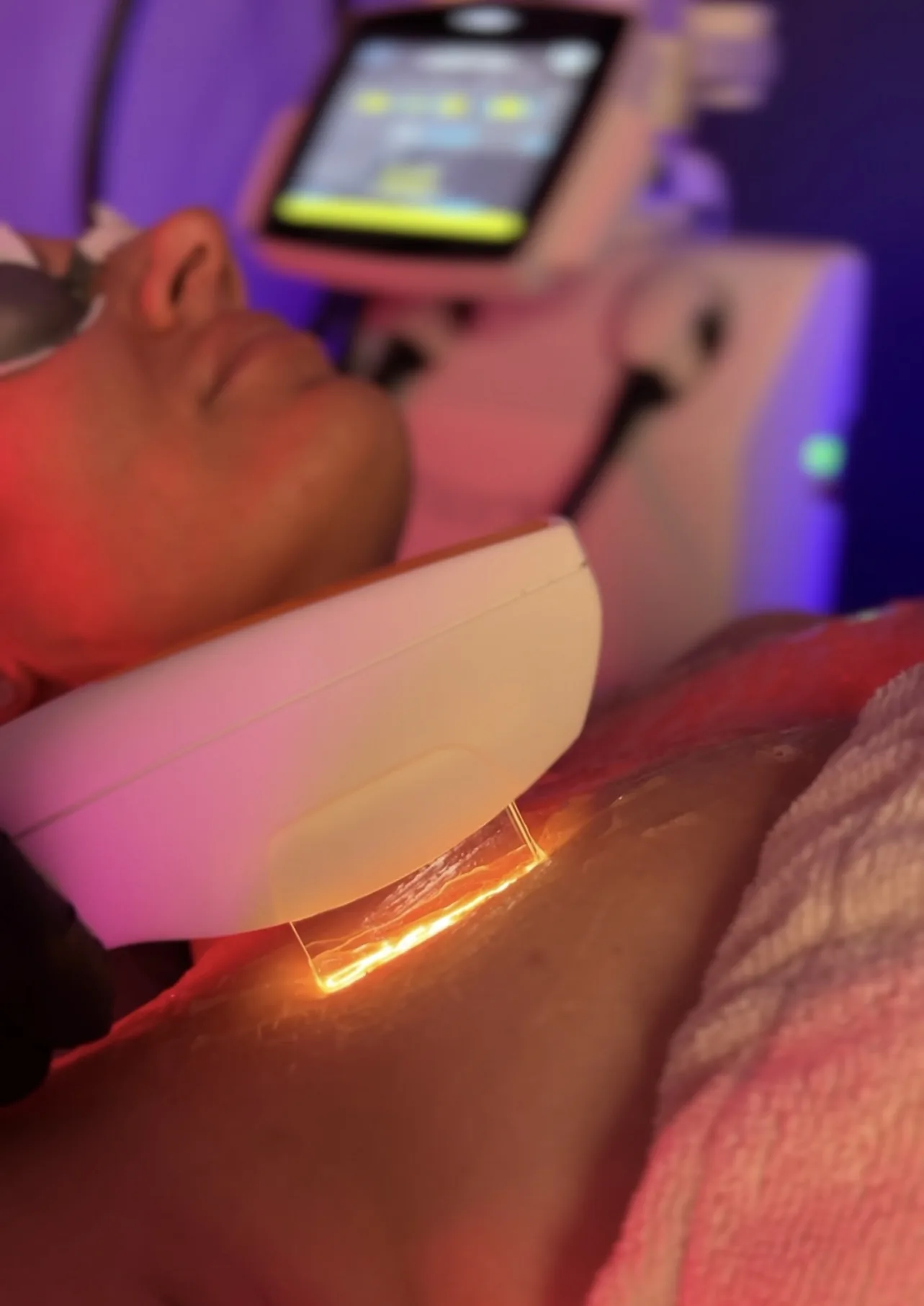 IPL treatment at NL Clinic in Katowice