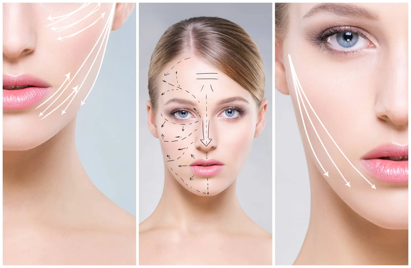 Directions for inserting lifting threads within the face