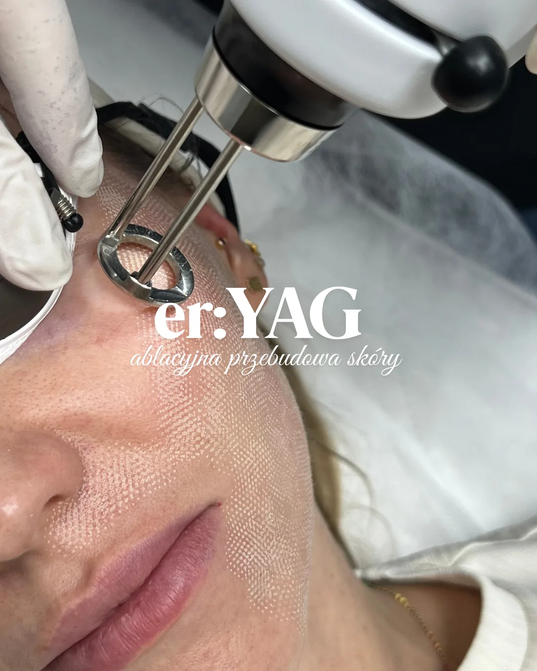 Zabieg laserem Er:YAG 2940 nm w NL Clinic w Katowicach