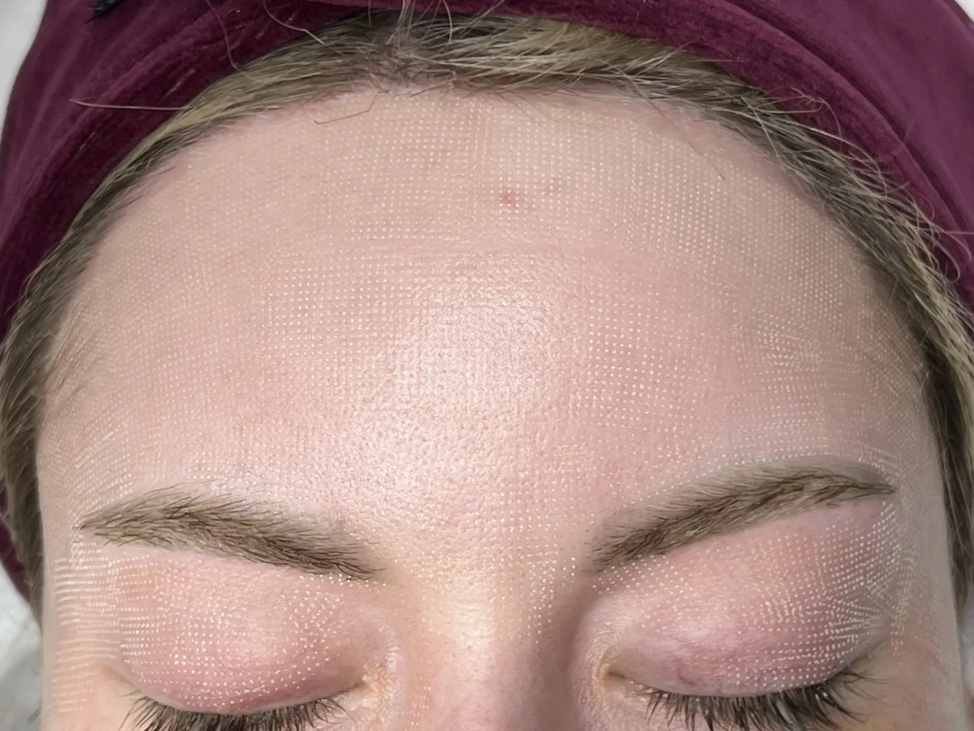 A fractional CO2 laser treatment for the face at NL Clinic in Katowice