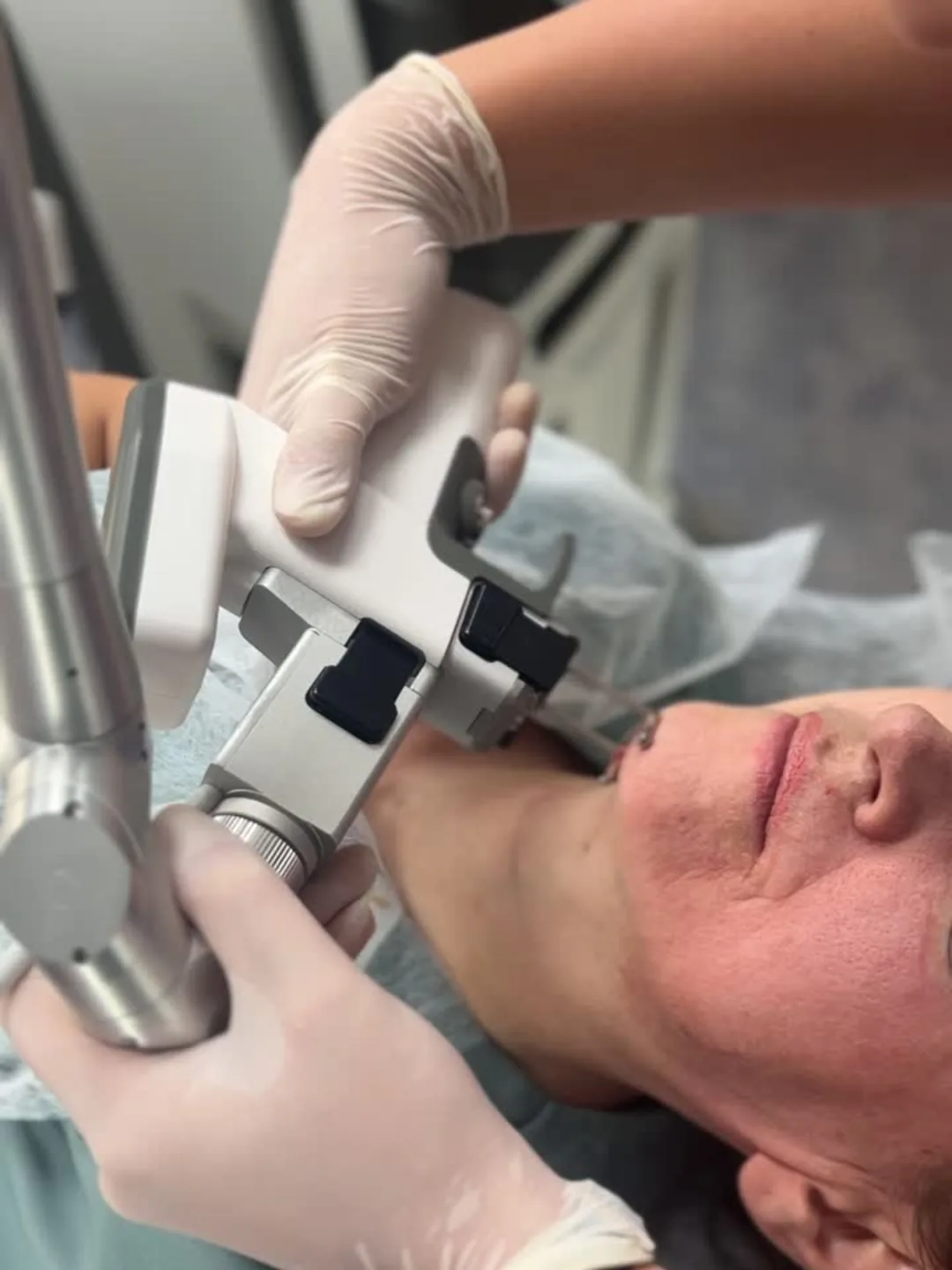 Gloved hands guiding the white scanner handpiece of the hybrid laser at the chin