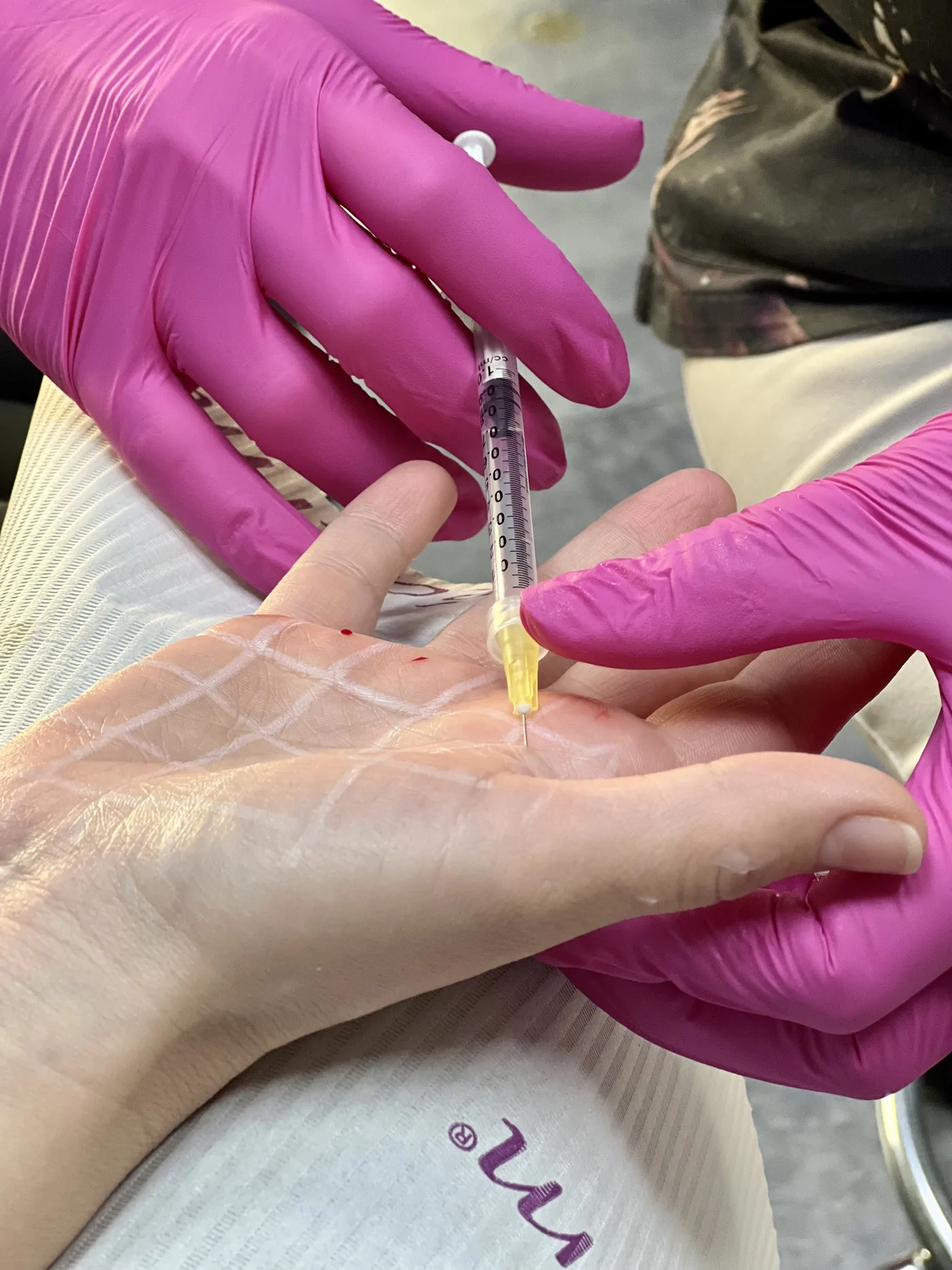 Leczenie nadpotliwości toksyną botulinową w NL Clinic w Katowicach