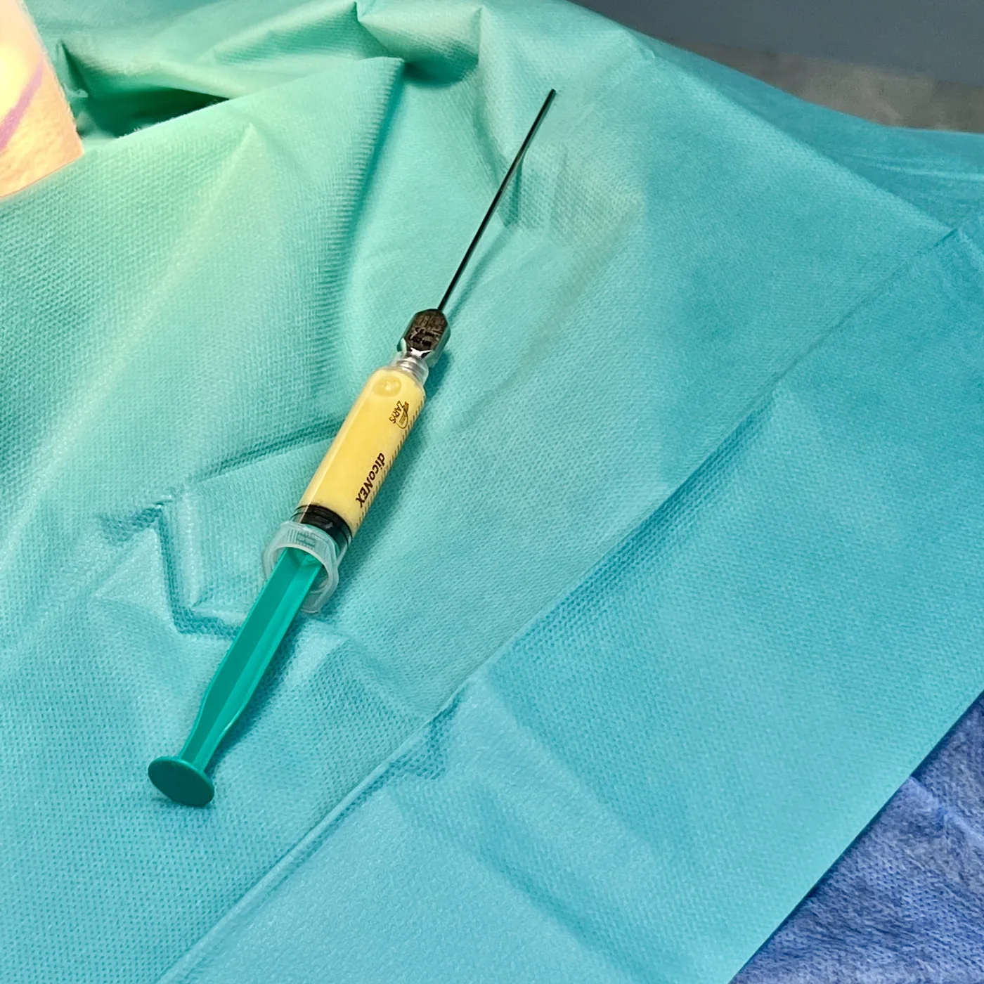 Syringe with a prepared fraction of fat tissue during a treatment at NL Clinic in Katowice