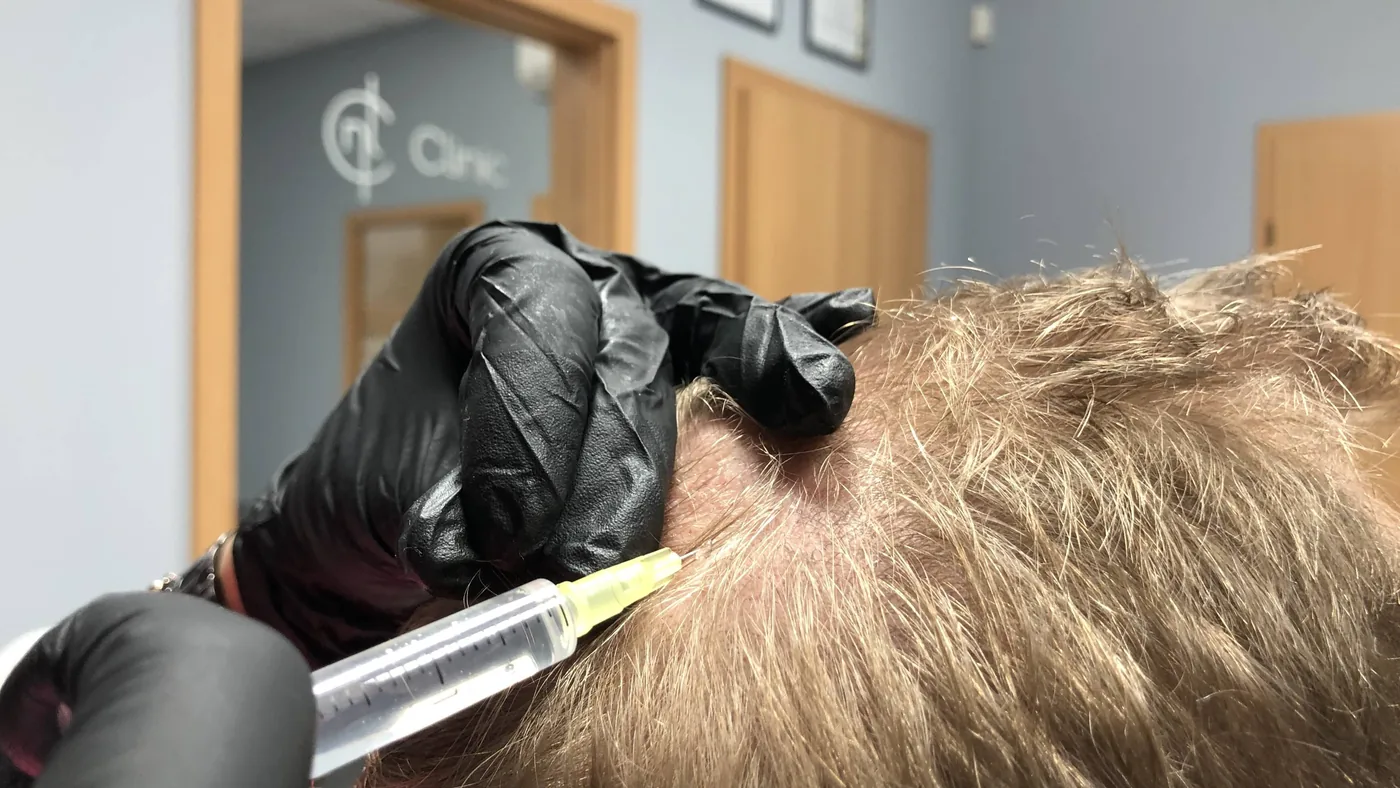 Scalp mesotherapy at the NL Clinic practice in Katowice