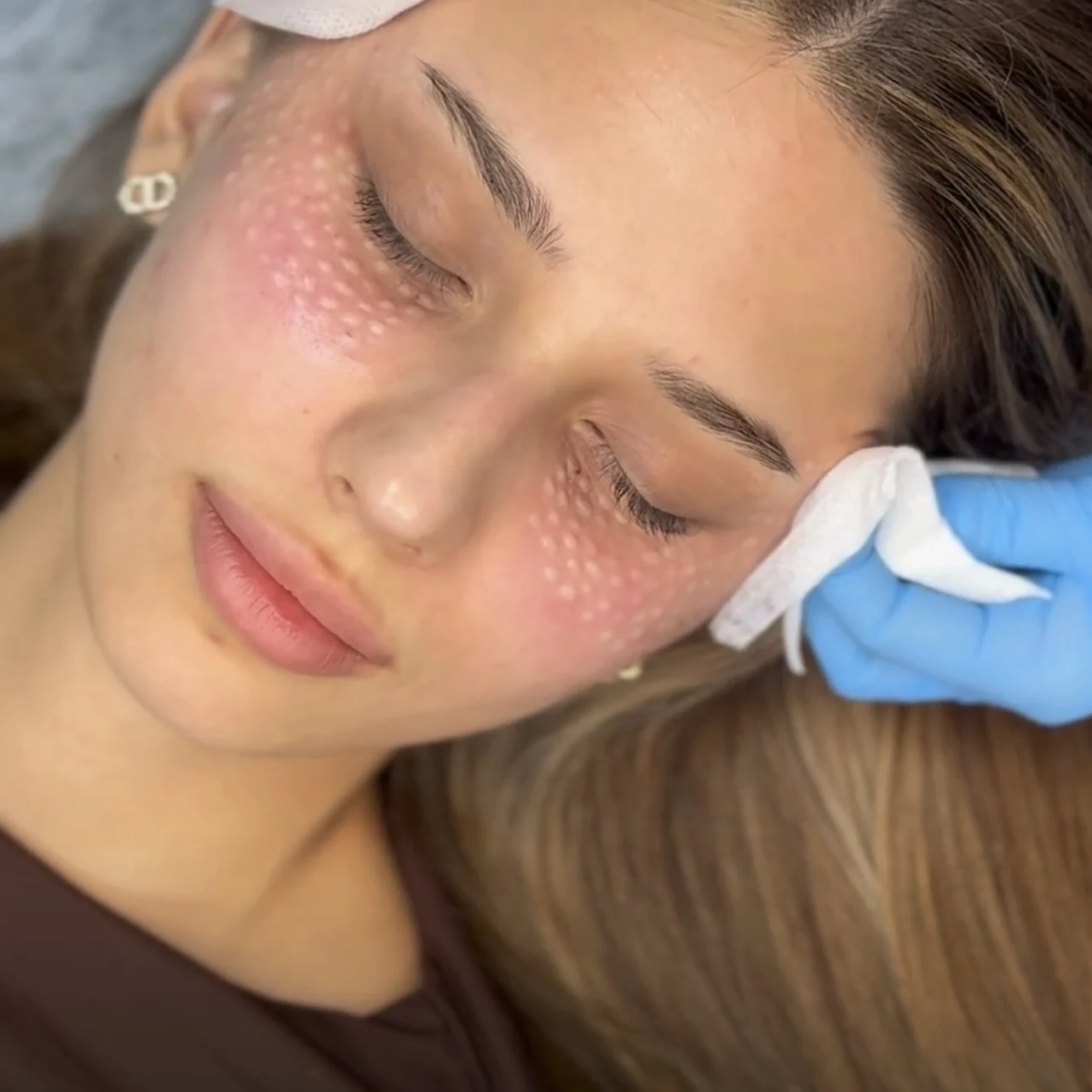 Hyaluronic acid micro-injections in the cheek area, NL Clinic Katowice
