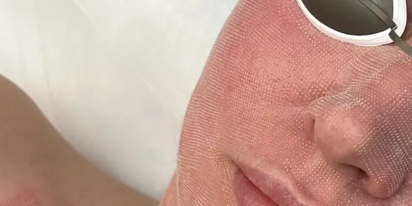 Preparing the skin before a laser treatment