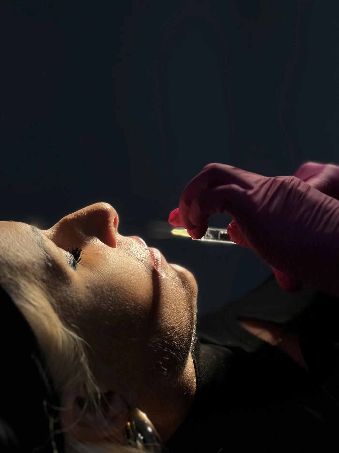 Lip contouring with hyaluronic acid at NL Clinic in Katowice