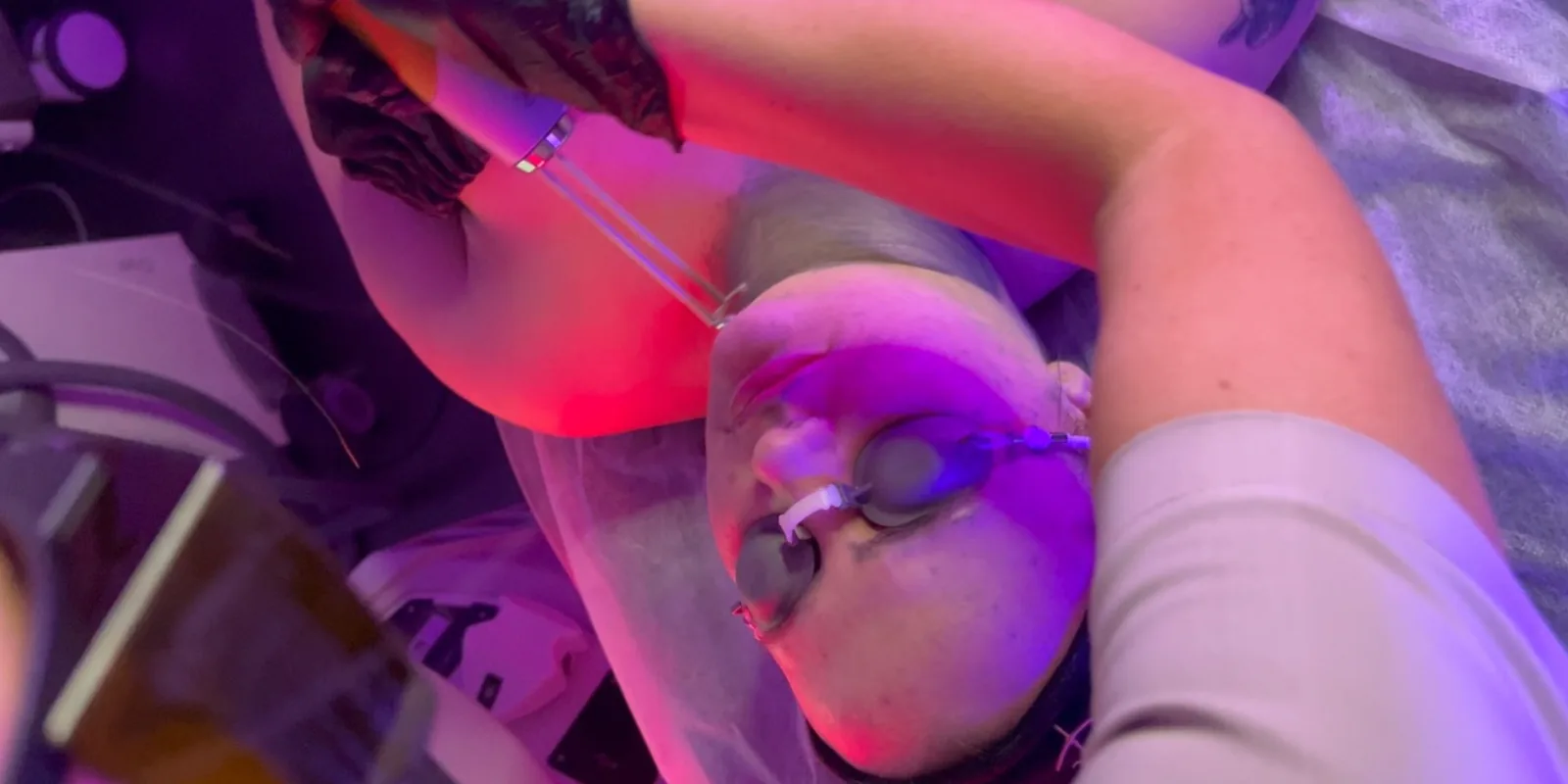 Sun protection after laser treatment