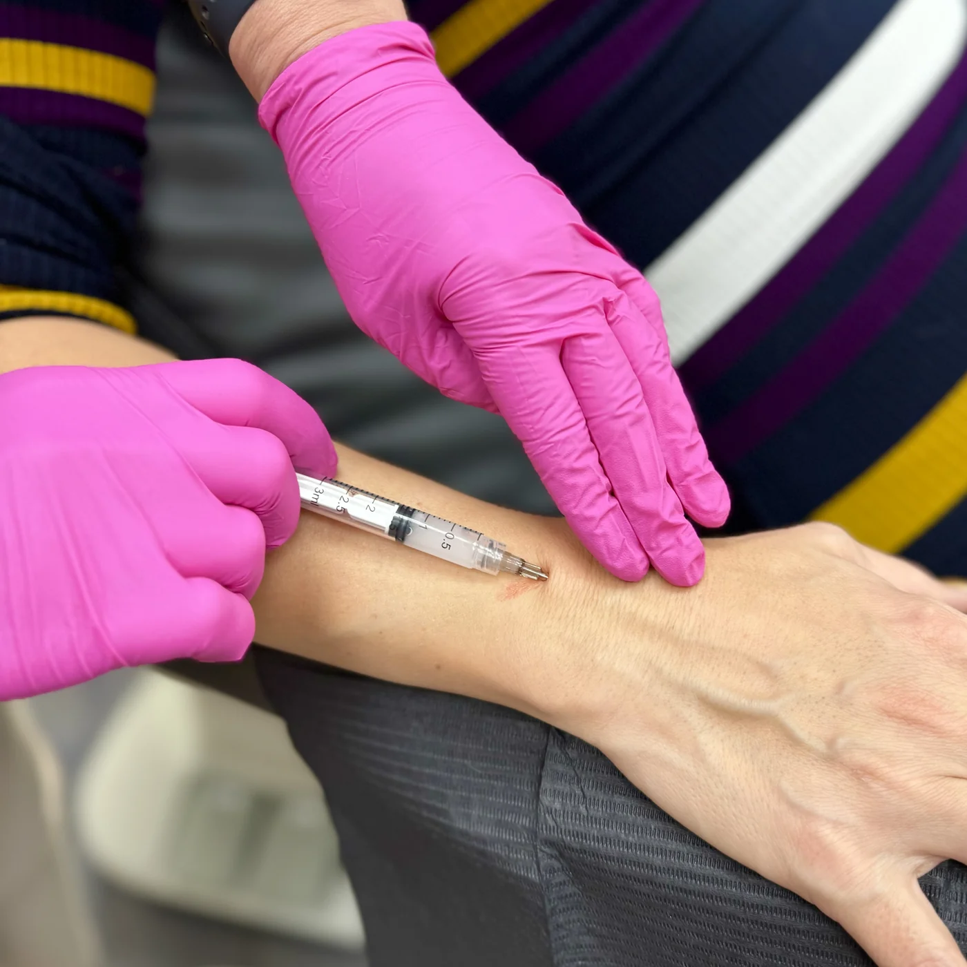 Administration of a poly-L-lactic acid biostimulator at NL Clinic in Katowice