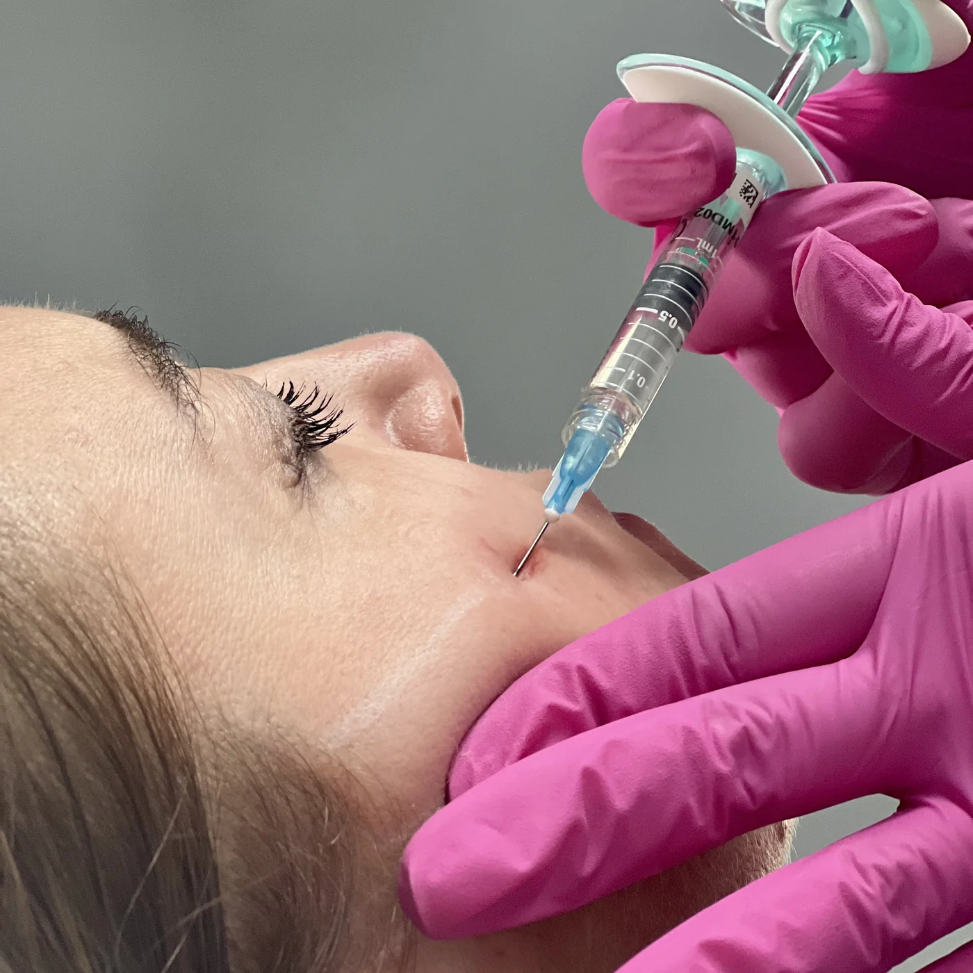 An injection of hyaluronic acid at NL Clinic in Katowice