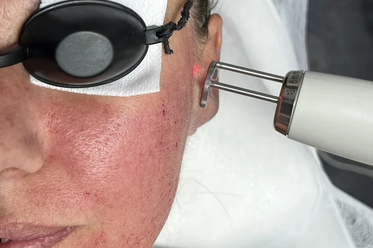 Working with a laser handpiece on skin with redness at NL Clinic in Katowice