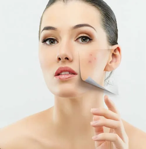 Acne-prone skin, illustrative photo