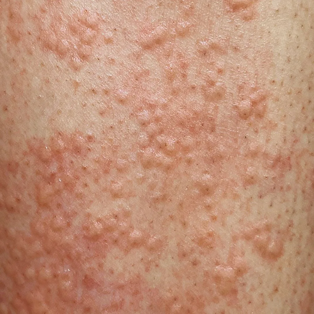 Skin immediately after laser hair removal with a visible reaction around the hair follicles