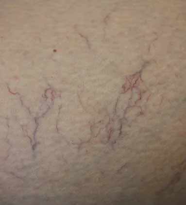 Vascular skin, illustrative photo