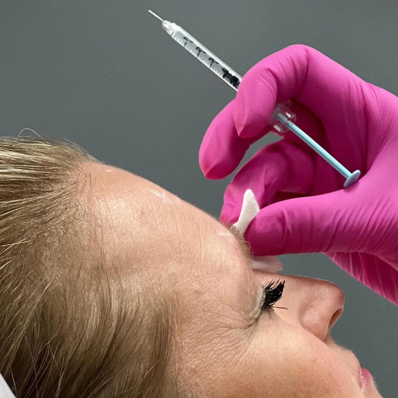 A treatment reducing expression wrinkles at NL Clinic in Katowice