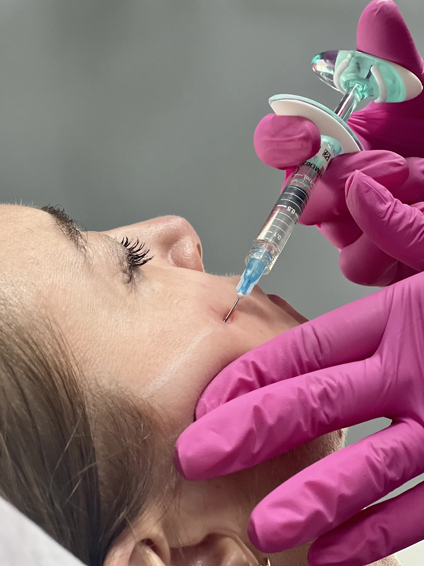 Wolumetria, dopełnienie policzka preparatem w NL Clinic