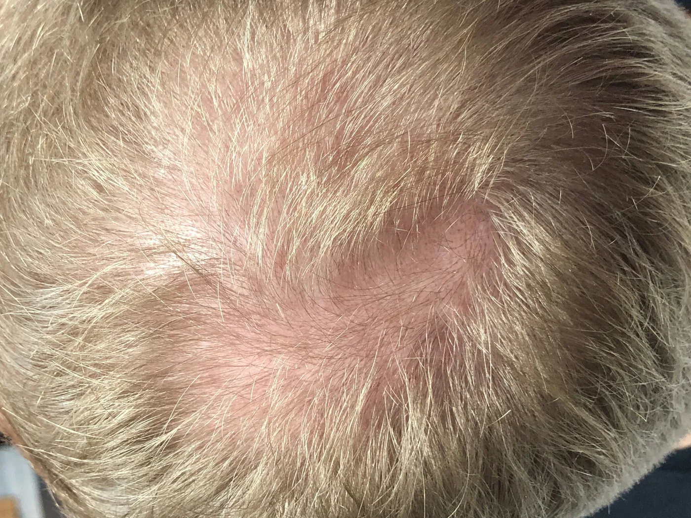 Scalp treatment, NL Clinic Katowice
