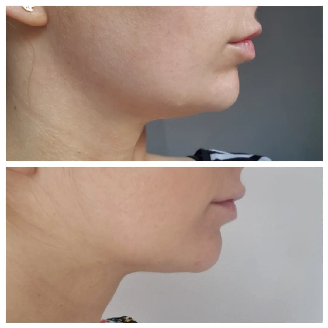 Fractional RF treatment at NL Clinic in Katowice