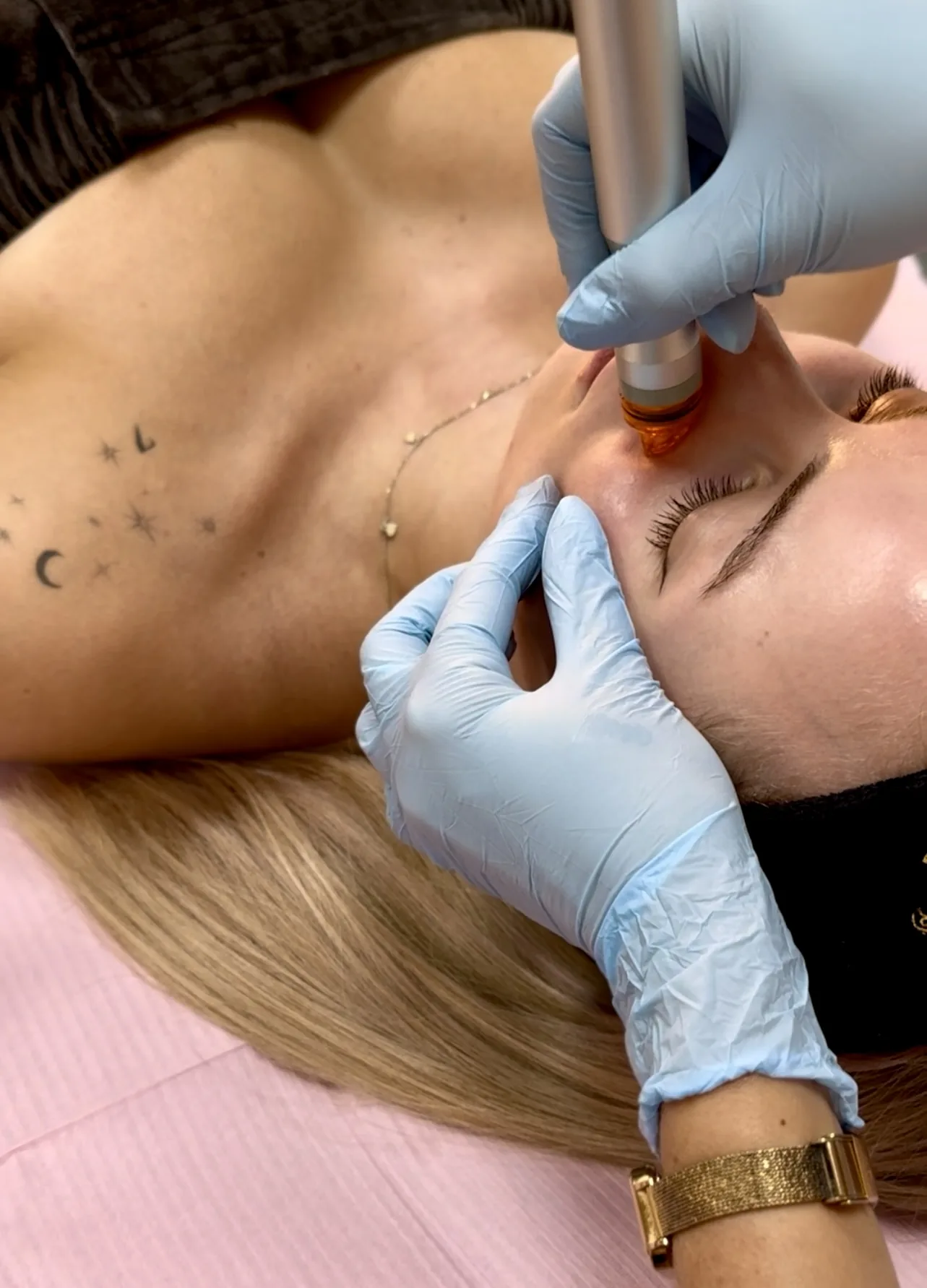 Hydradermabrasion treatment at NL Clinic in Katowice