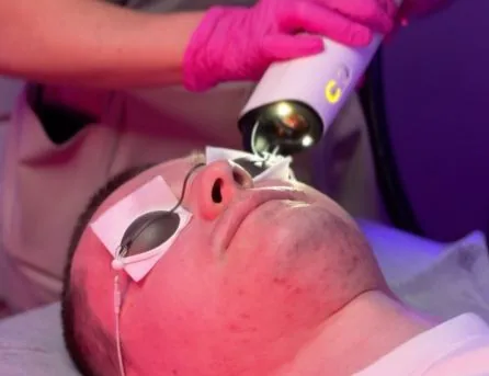 A combined treatment of microneedle RF and thulium laser