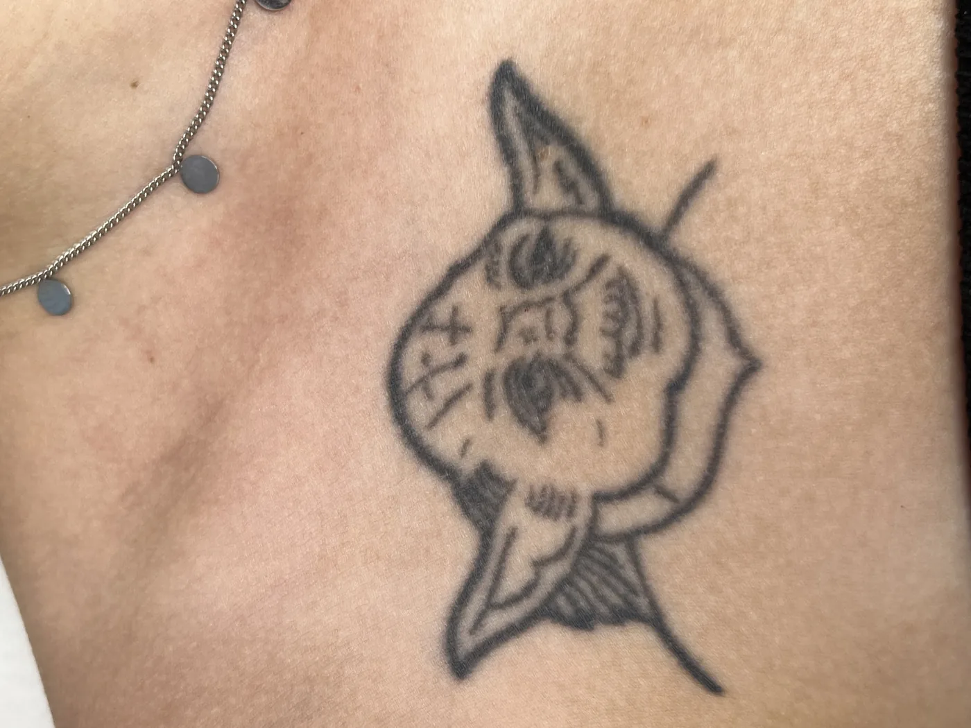 Laser tattoo removal treatment at NL Clinic in Katowice