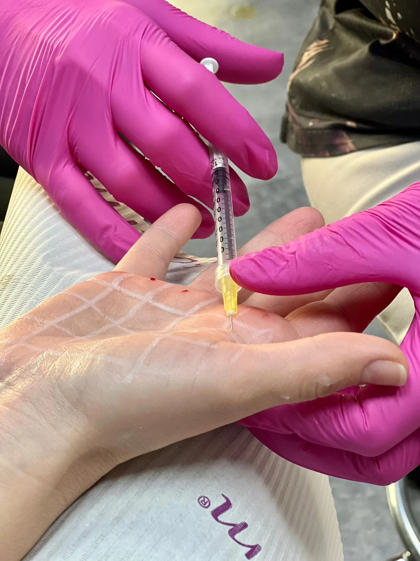 Treatment for hand hyperhidrosis at NL Clinic in Katowice