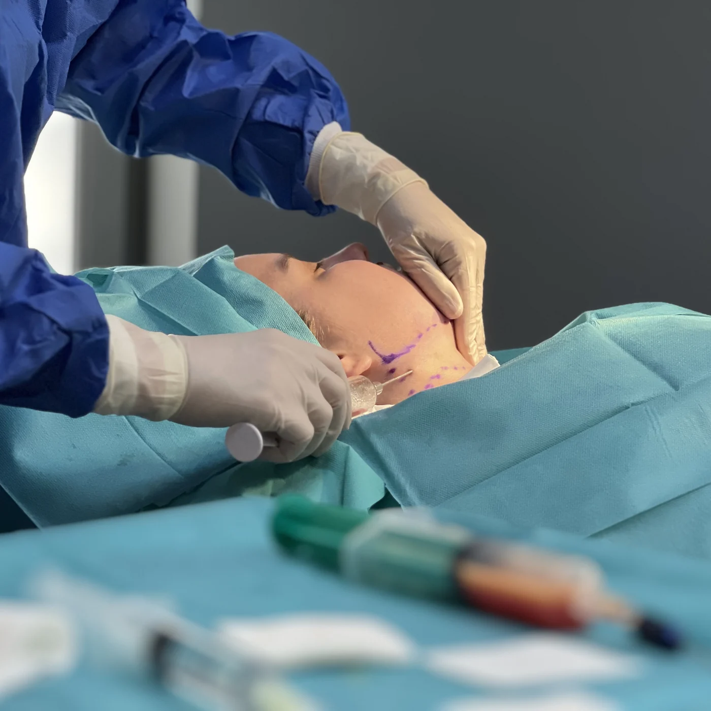 Facial fat transplant treatment at NL Clinic in Katowice