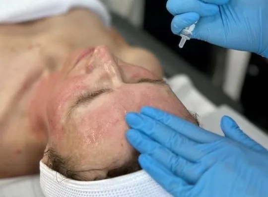 Skin regeneration treatment after summer at NL Clinic in Katowice