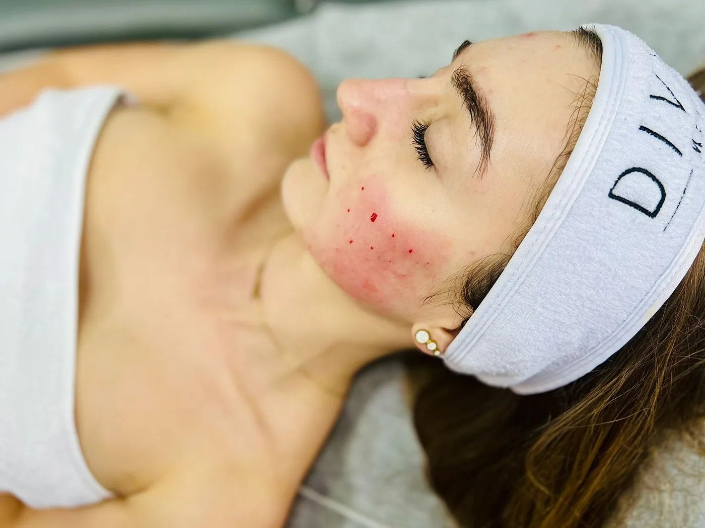 A treatment with a tissue biostimulator at NL Clinic in Katowice