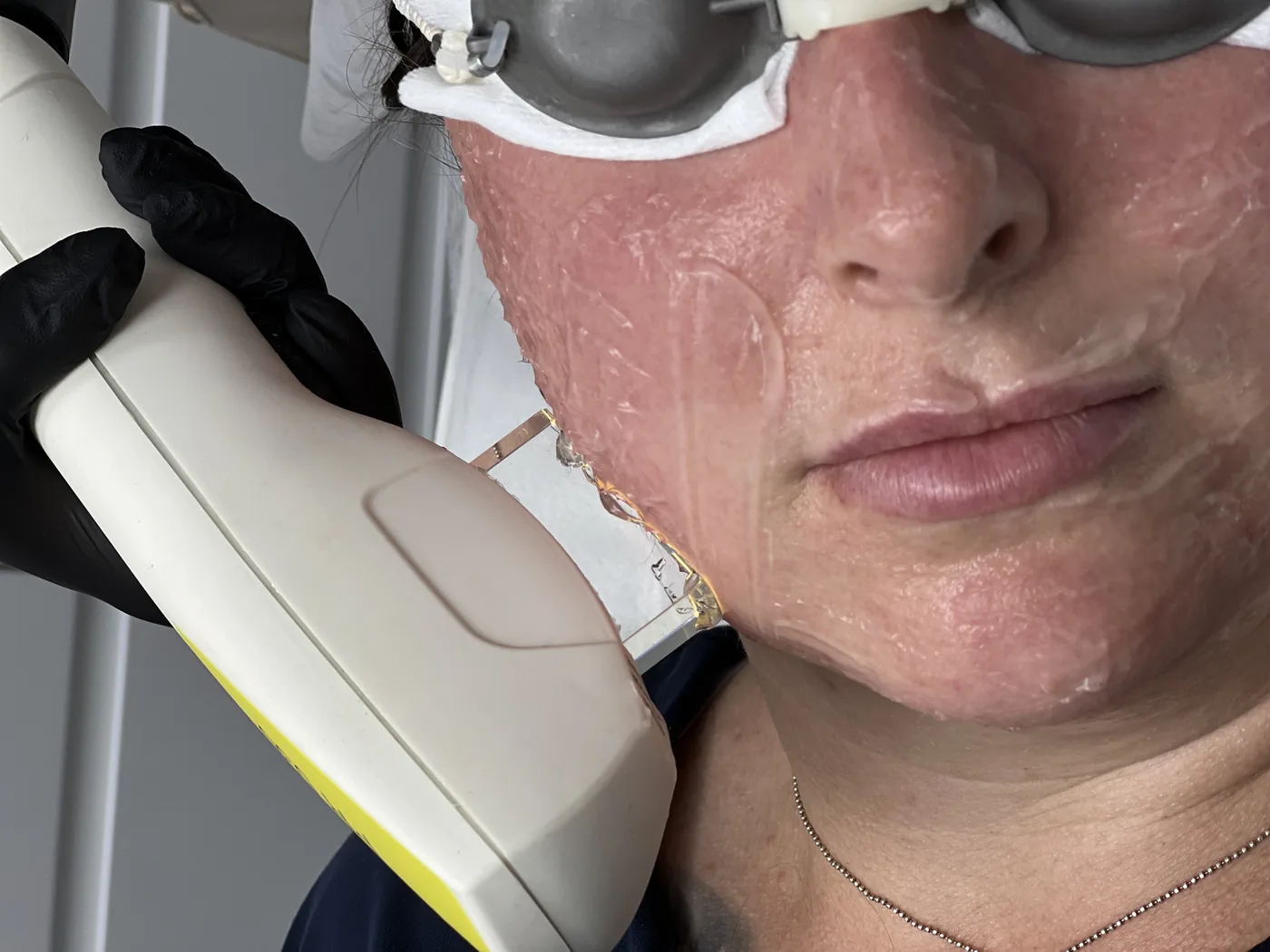 Reduction of redness and vessels with IPL light at NL Clinic